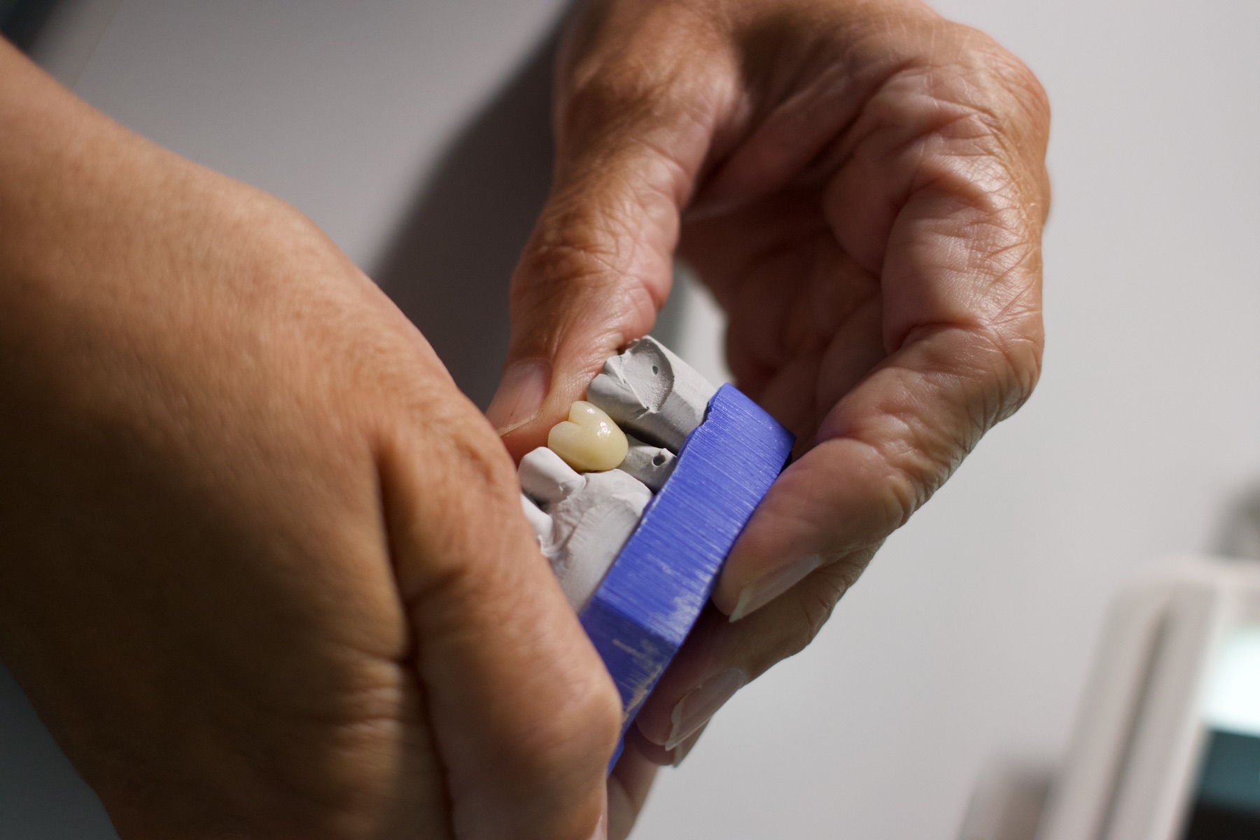 Keramik-Implantat im Gips-Modell, Detailansicht der Krone