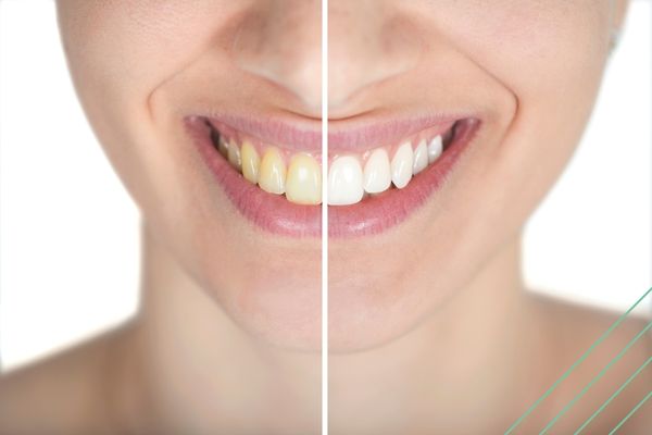 Bleaching oder Zähne natürlich aufhellen? Was ist gesünder & bringt weißere Ergebnisse?